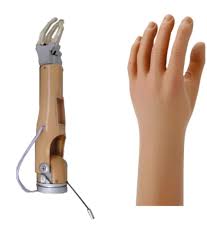 Steeper    Mechanical AE Hand  Prosthesis