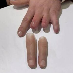 Regal Prosthesis   Custmade Silicone Finger Prosthesis