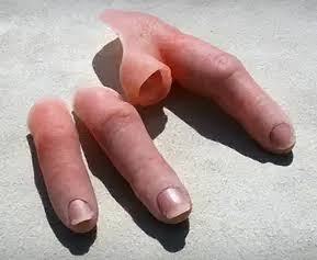 Regal Prosthesis   Custmade Silicone Finger with Band Prosthesis