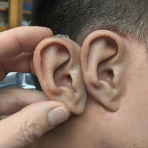 Regal Prosthesis   Custmade Silicone Ear Prosthesis