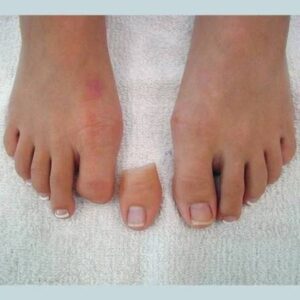 Regal Prosthesis  Custmade Silicone Toe Prosthesis